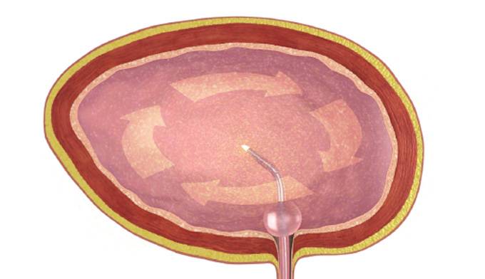 Tratamiento de cáncer de vejiga